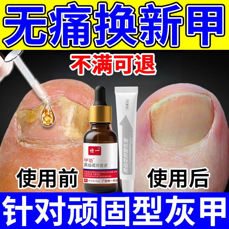 去灰指甲特药水效一滴净抑菌液增厚变黄空甲真菌感染无痛脱甲膏