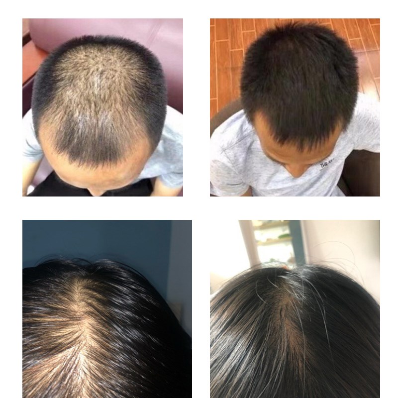极速Gingeer Hair Growth Hair Essential Oil Prevent Hair Loss