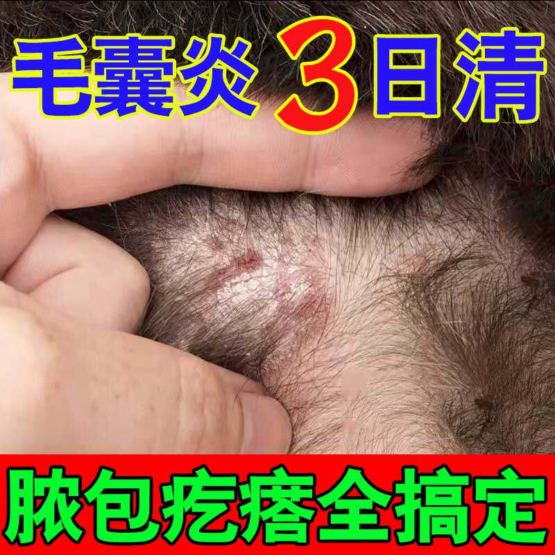 极速头毛囊焱头部焱痤头上脸部前胸後背长疙瘩X痘痘除蟎专用