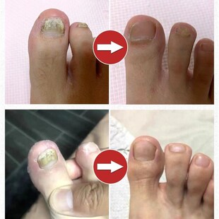 极速脚指甲增厚变黄灰甲神器脚趾B甲变厚发黄变硬黄指甲盖坏甲变