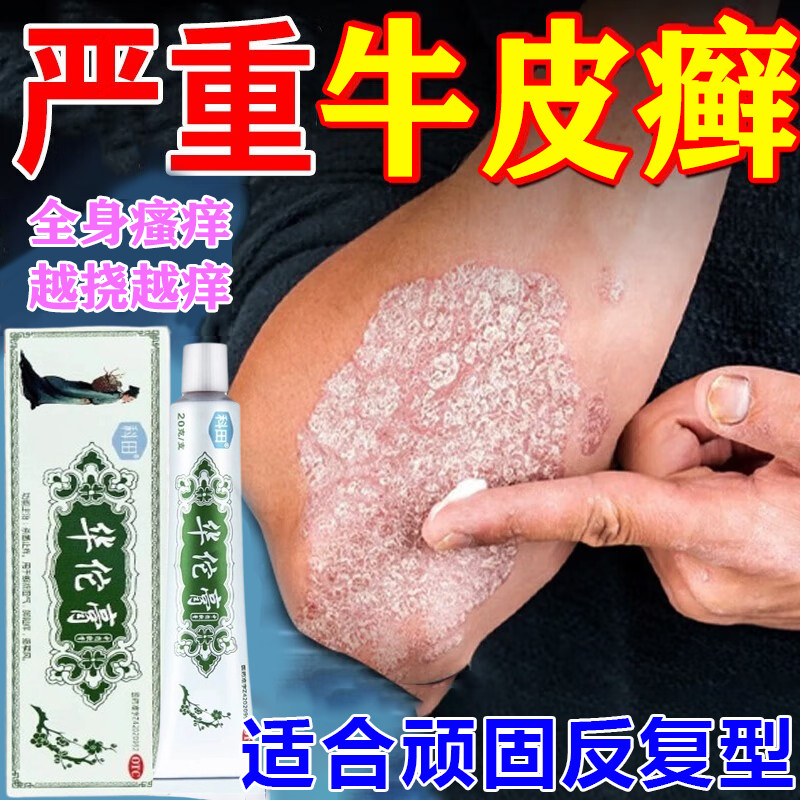 牛皮癣专用药皮肤瘙痒红肿银屑病顽皮藓癣鹅掌风正品杀菌止痒抑菌