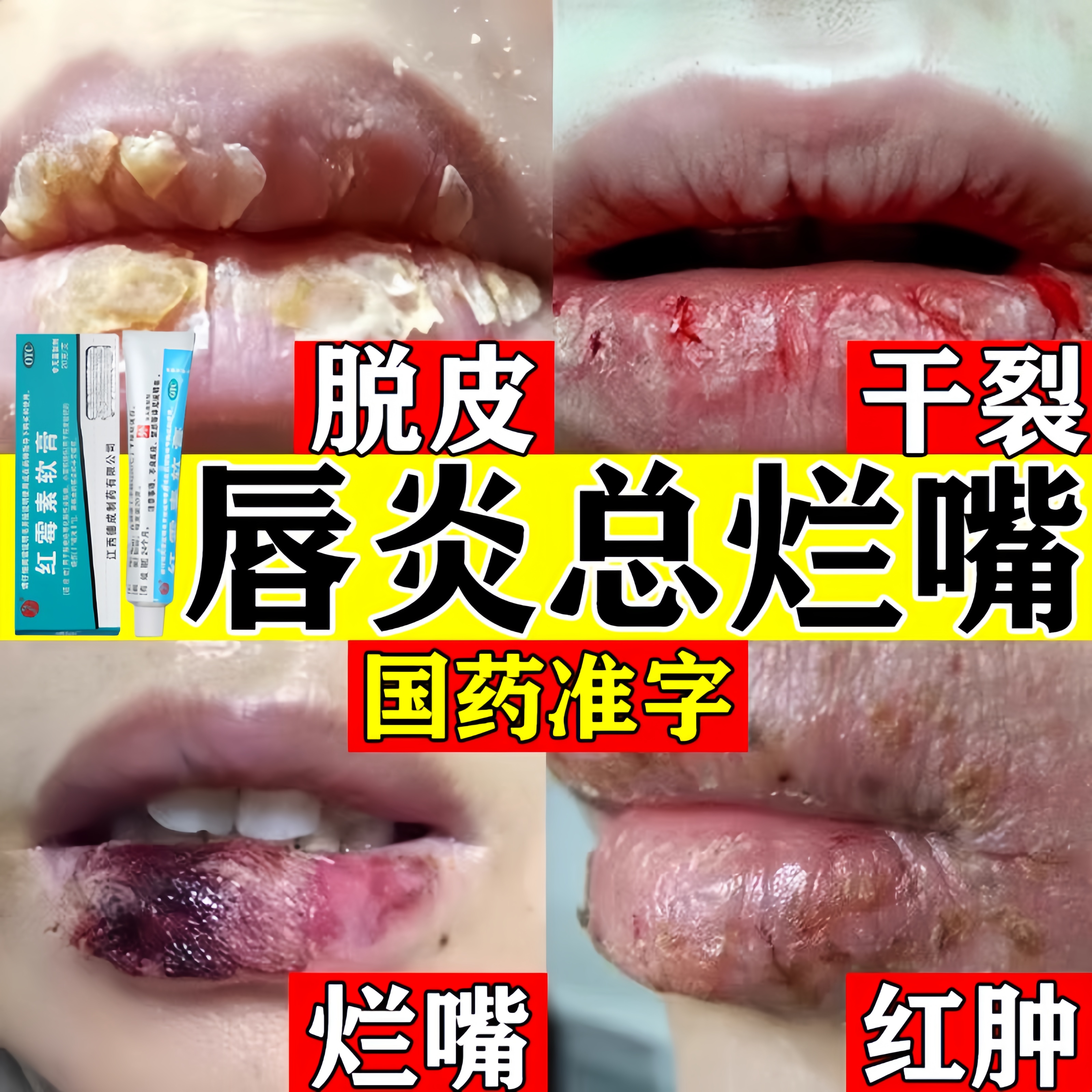 唇炎专用药膏成人儿童抗菌消炎唇炎唇膏嘴唇干裂脱皮医用型嘴烂