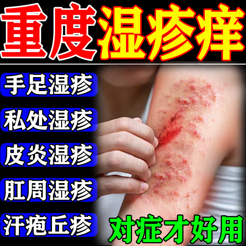 止痒药膏蚊虫叮咬皮肤瘙痒外用的效特去痱子大人专治抑菌湿疹过敏