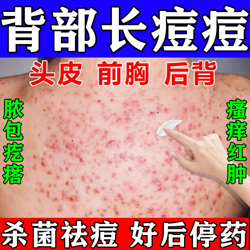 前胸后背长痘痘毛囊炎专特用效药膏痤疮疙瘩螨虫止痒莫匹罗星软膏