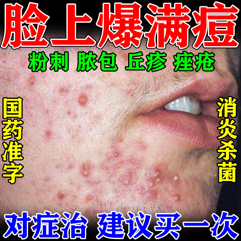 胶态硫软膏祛痘杀菌软膏外用软膏酒糟鼻玫瑰痤疮祛痘药膏消炎