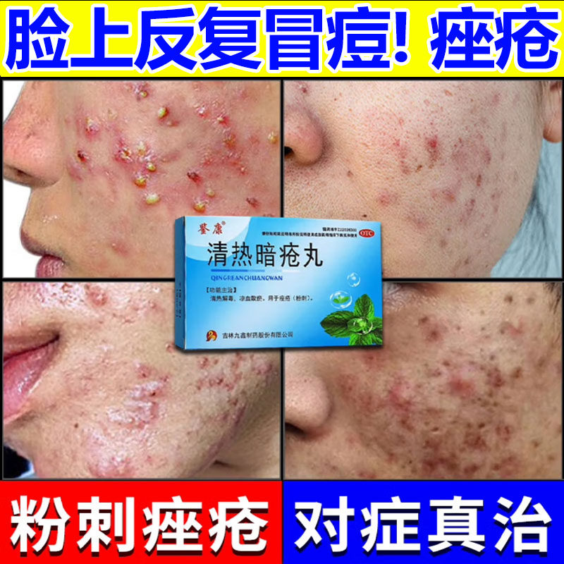 【鉴康】清热暗疮丸60丸/盒