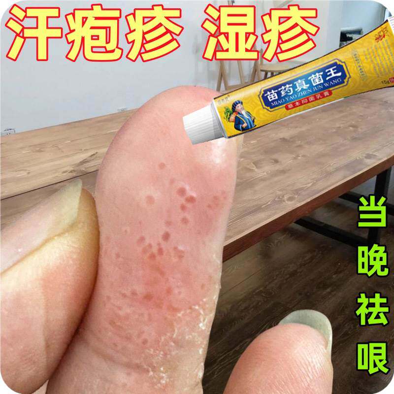 汗泡疱疹药膏手上起小水泡汗状疱疹止痒汉状真菌感染手气专用软膏