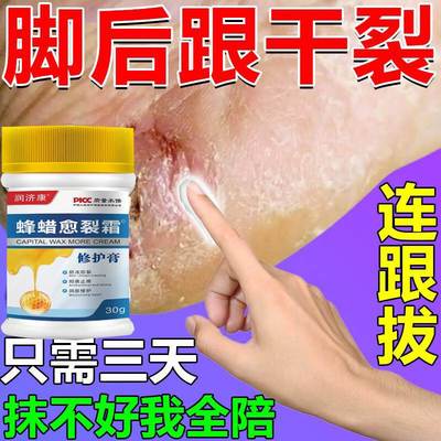 专治脚裂脚后跟干 干裂修覆霜脱皮真菌感染脚底足跟起硬皮开 裂口