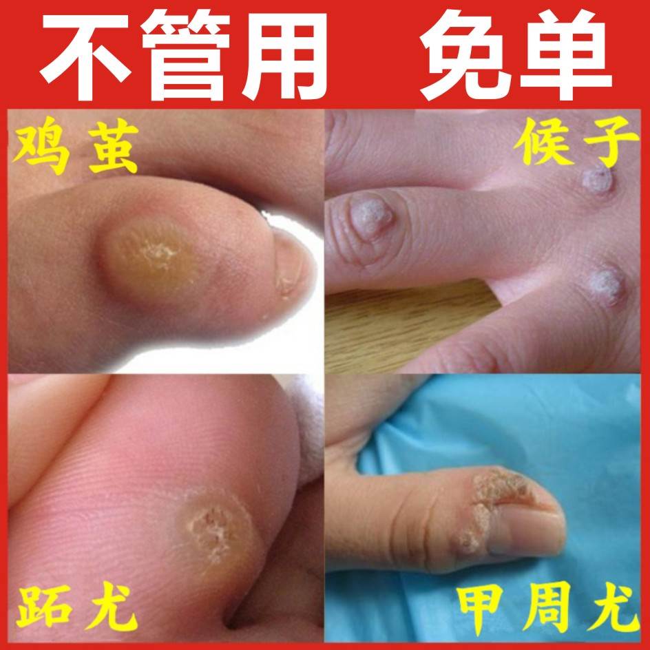 瘊子刺猴去除足部脚底疣手部跖疣专用膏去根鸡眼贴肉刺老茧神器