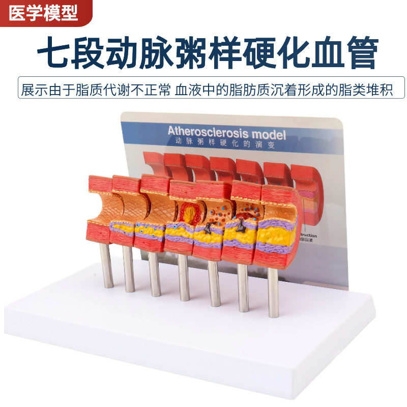 七阶段血脂变化人体血管血液浓度脂肪病理血液血管粥样人体血管病