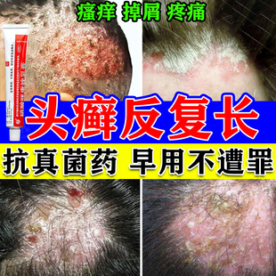 头癣药膏治头皮癣头部红斑瘙痒真菌感染结痂屑硝酸咪康唑乳膏正品