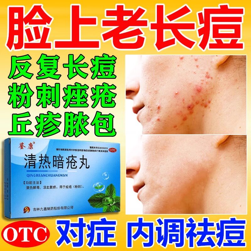 清热解毒痤疮丸专治痤疮用效药玫瑰痤疮座疮特消炎祛痘内调口服药