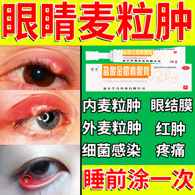 麦粒肿眼药膏霰粒肿针眼红肿眼皮红肿痒细菌感染盐酸金霉素眼膏