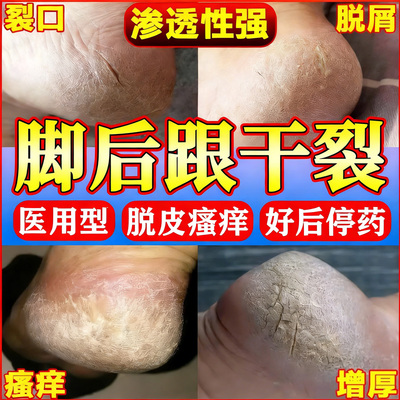 【康欣诺泰】环吡酮胺乳膏20g*1支/盒