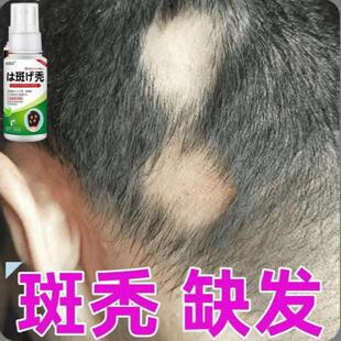 鬼剃头谢顶秃顶防脱突发斑性秃营养液特效鬼剃头特育发效生姜发根
