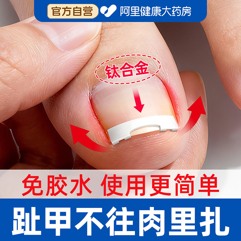 正甲扣甲沟嵌甲矫正器脚趾甲长肉里专用弯卷甲贴片指甲矫正器神器