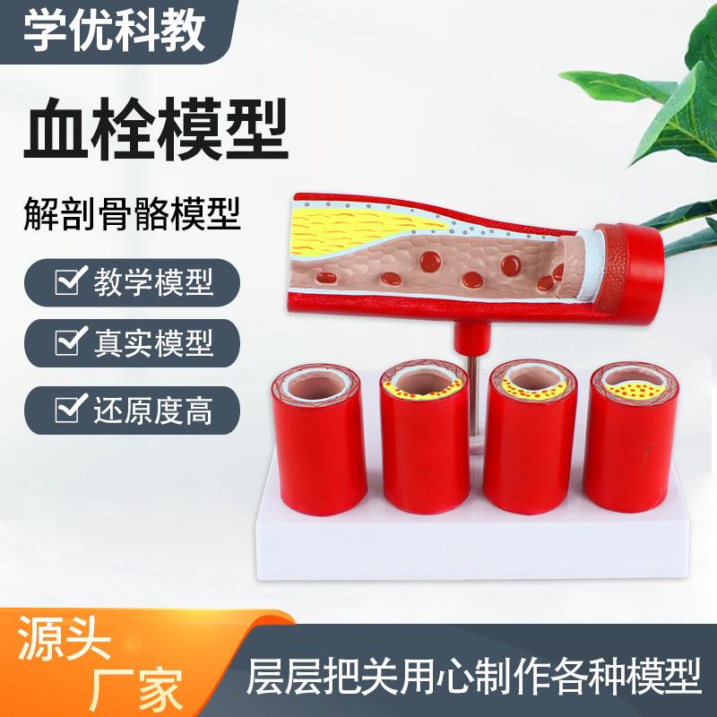 心血管动脉冠状动脉状模型老年支脉硬化形成血栓模型人体血管模型