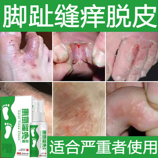 脚痒水泡型脱皮烂脚丫脚脚趾缝糜烂脚气止痒脱皮杀菌真菌感染喷雾