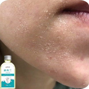 秋冬季嘴巴周围脱皮起皮掉皮脸上干燥起干皮干痒脸部白屑粗糙干燥