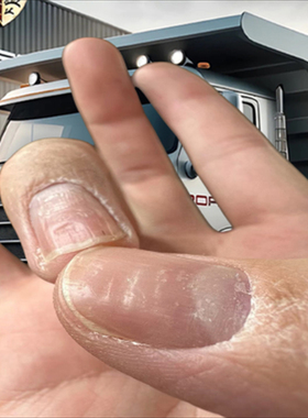 指甲黑色竖纹黑线中指指甲里面有黑线手指甲真菌感染去指甲黑线膏