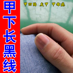 指甲黑线空甲甲营养不良变脆甲下出血甲母痣专用修复药乳