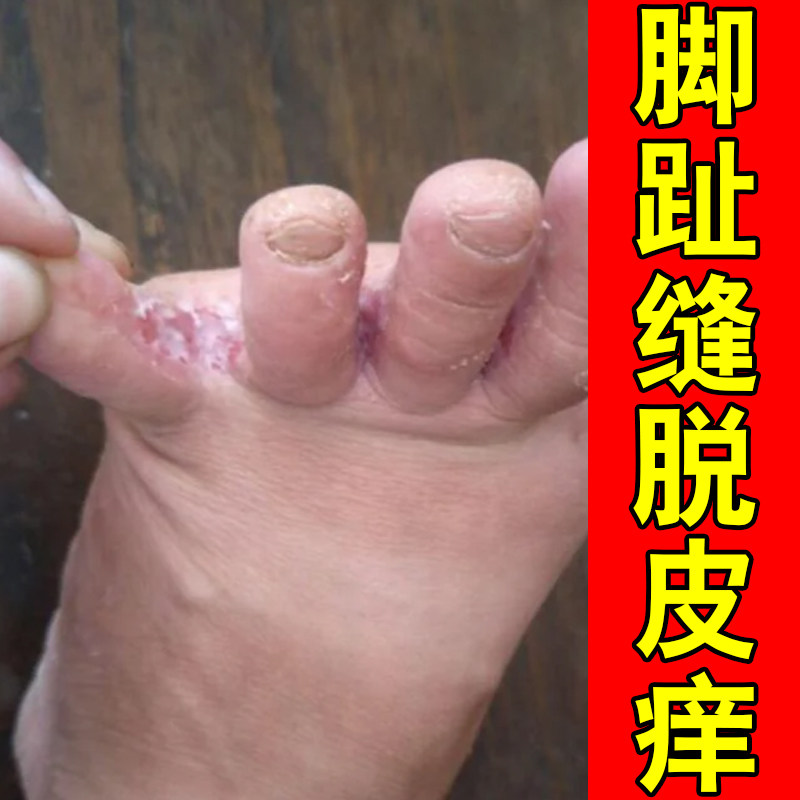 脚趾缝脱皮痒掉屑红肿脚底长小水皮肤消毒护理（消）