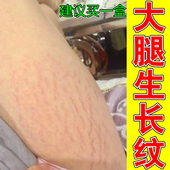 大腿生长纹妊娠纹膨胀纹专用修复身上胳膊上红白色纹肥胖纹淡化纹