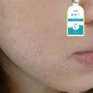 嘴边干燥起皮干皮脸上起皮掉皮干皮脸起皮发痒脸上起皮干燥脸干痒