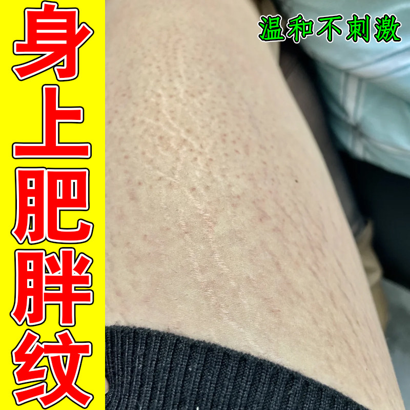 肥胖纹修复霜去除生长纹消除大腿皮肤消毒护理（消）