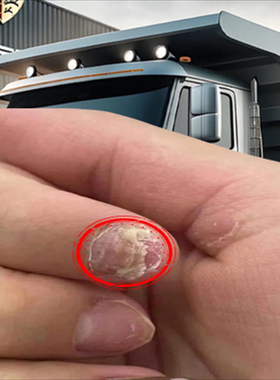 甲母痣指甲黑色竖纹黑线大拇指指甲里面有黑线手指甲真菌感染修复