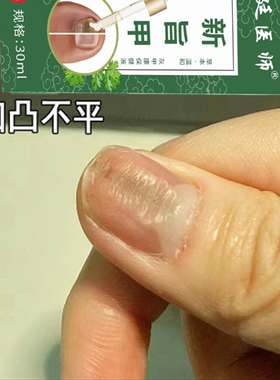 指甲黑色竖纹黑线指甲盖有竖纹手指甲真菌感染手指指甲盖凹凸不平