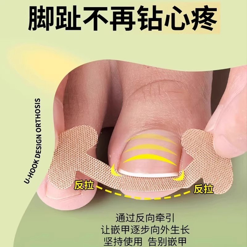 甲沟神器指甲矫正器隔离脚趾神器