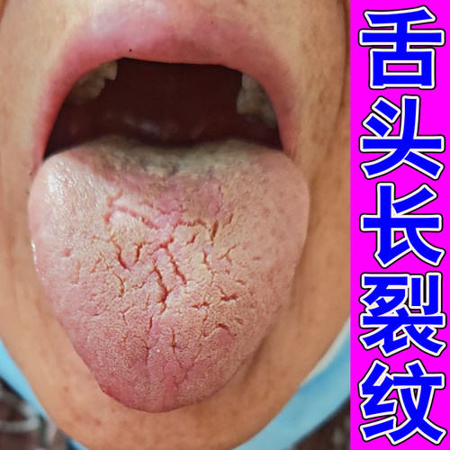 冶舌头裂纹痕舌有裂纹舌头发白裂纹舌舒缓喷雾