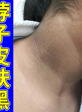 脖颈黑黑的洗不干净脖子黑色素去后专用黑色素沉淀霜