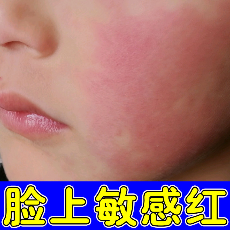 去脸上红血丝修护角质层屏障脸颊皮肤消毒护理（消）