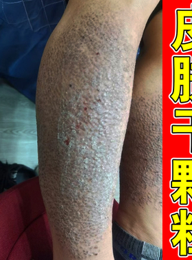 专用膏冶胳膊小腿背皮肤粗糙颗粒顽固皮肤黑色素沉淀