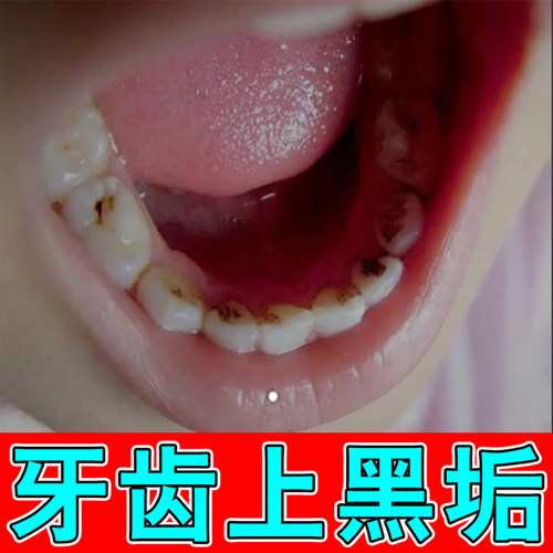 祛儿童牙齿黑色素沉淀去黑线黑渍黑牙黑斑牙菌斑专用