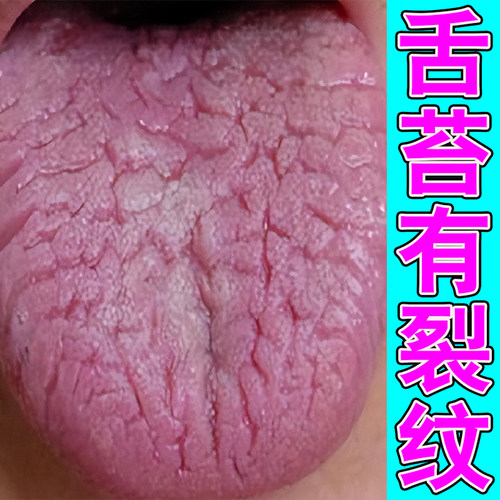 舌头裂痕舌头上有裂纹舌苔厚白舌头开裂肿胀灼烧喷雾剂
