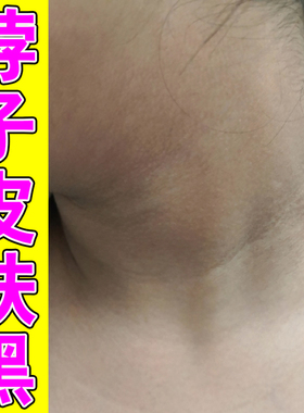 脖子黑色素沉淀洗不干净去脖子黑色素黑皮