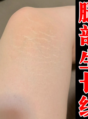 腿部生长纹白色纹理腿上长肥胖纹学生成人大腿膝盖膨胀纹修复霜膏