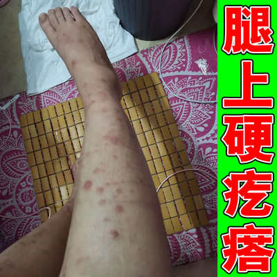 结节疙瘩分散生长在皮肤各处结节类凸起皮损专用