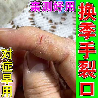 手足起皮抑菌膏严重蜕皮专用干燥起皮粗糙裂口手指开裂修护膏