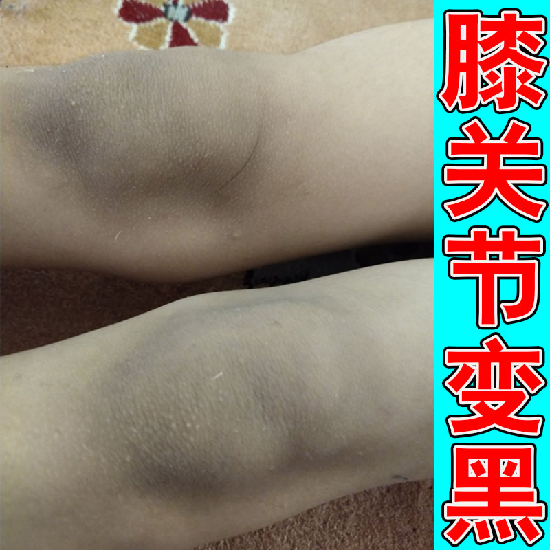 胳膊肘黑去死皮手肘膝盖关节黑皮皮肤消毒护理（消）
