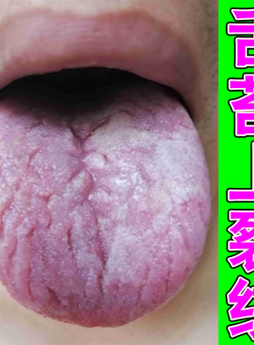 舌头有裂纹发热灼口综合证口腔发麻调理舌面