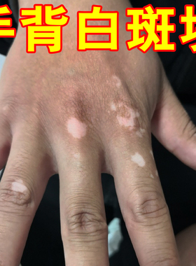 手背上白块专用长白斑外用修护促黑色素乳膏