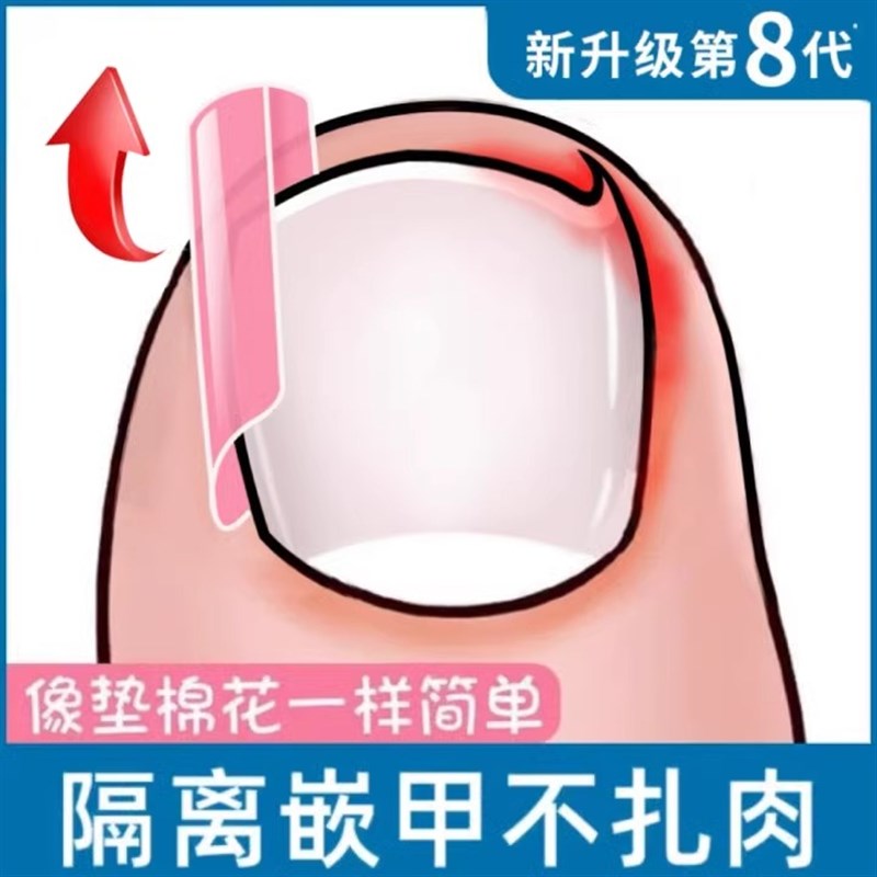 脚趾指甲矫正器甲沟隔离填充垫片嵌甲神器防止指甲往肉里长炎
