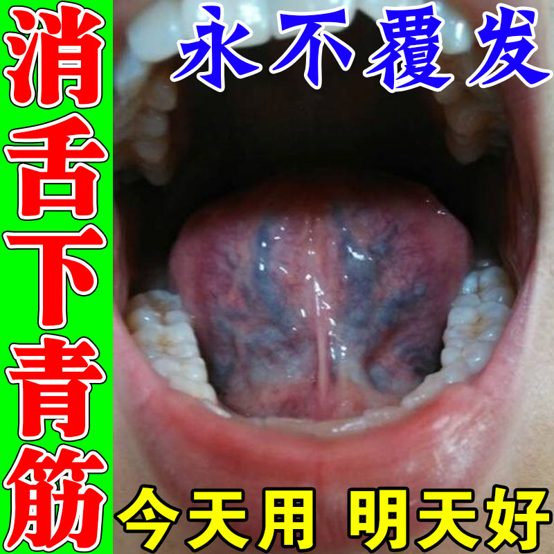 舌下青筋凸起筋络发紫舌