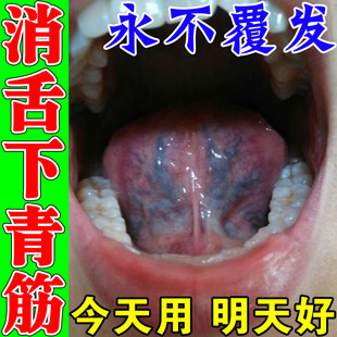 舌下青筋凸起筋络发紫舌头冷黑紫粗大淤血疏通舌头底血管怒张喷剂