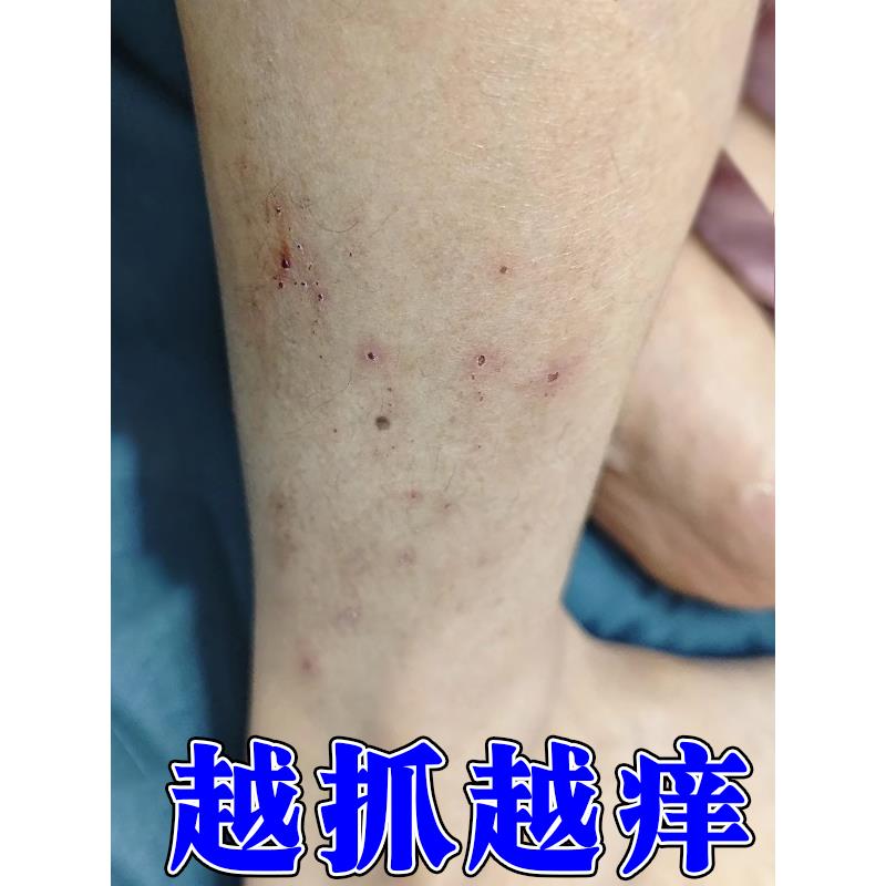 小腿皮肤痒起红疙瘩天热