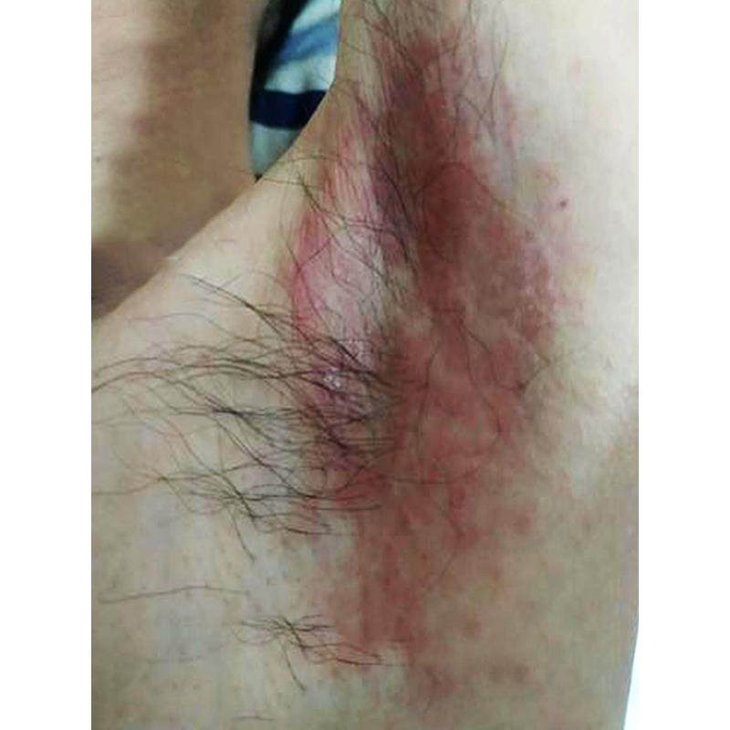 腋下淹红胳肢窝起红斑小疙瘩痘痘红痒腋窝发红腋毛痒白色附着物药,洗护清洁剂/卫生巾/纸/香薰,身体乳液,淘宝优惠券,粉丝福利购,淘宝优惠卷